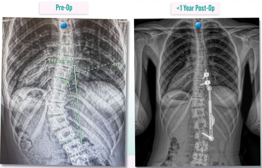 Before and after image for Apifix procedure