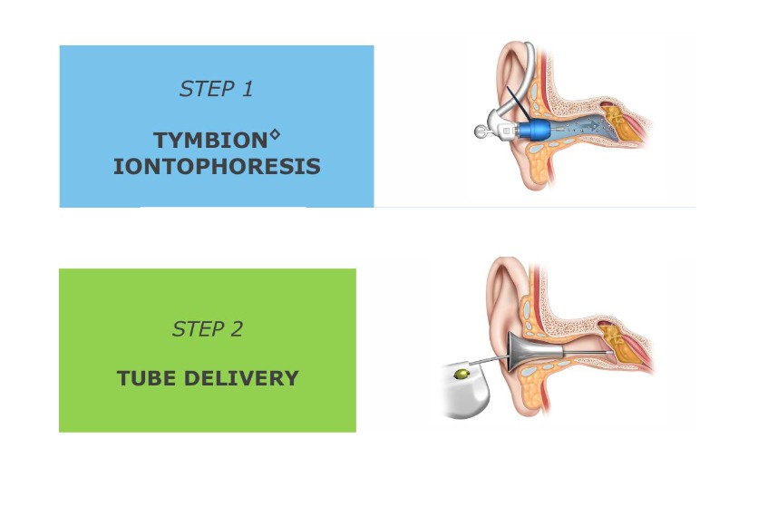 Tula ear tubes